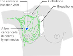 Fig.1 Illustration of stage 1 breast cancer