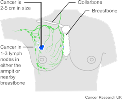 7BUIS008W.1 Fig.2 Illustration of stage 2 breast cancer