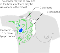 7BUIS008W.1 Fig.3 Illustration of stage 3 breast cancer