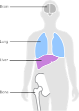 7BUIS008W.1  Fig.4 Illustration of stage 4 breast cancer